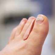 Medische pedicure - Orthese